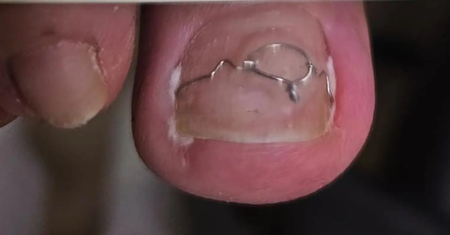 Podologie-Noa-toe mit 3-teiliger Orthonyxie-Schiene